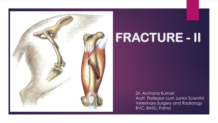 fracture fracture ii ii