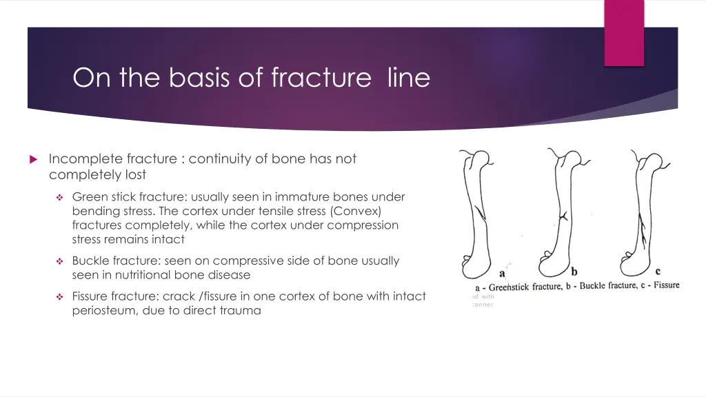 on the basis of fracture line