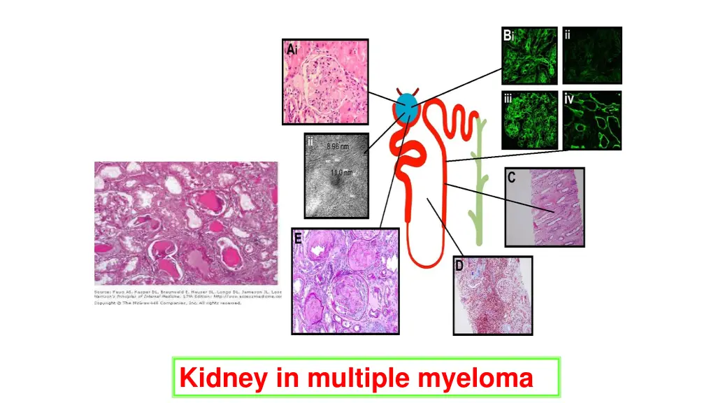 kidney in multiple myeloma
