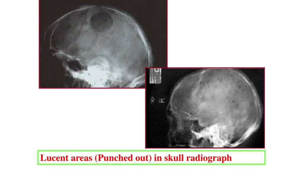 lucent areas punched out in skull radiograph
