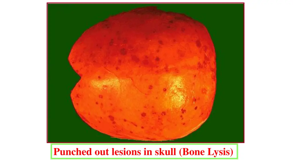 punched out lesions in skull bone lysis