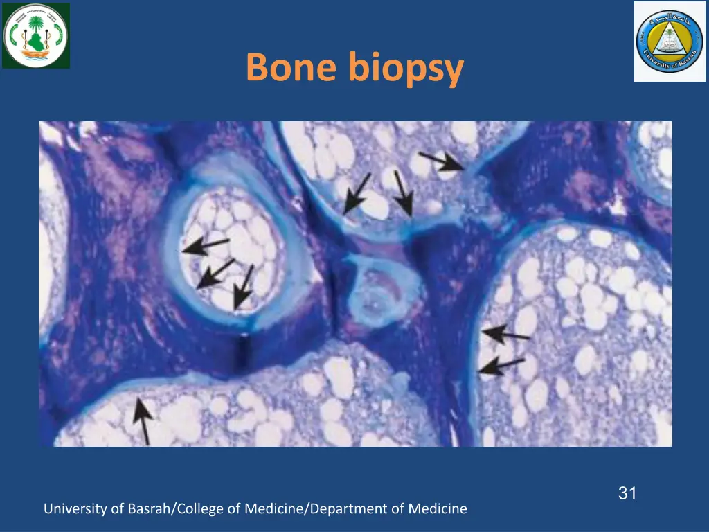 bone biopsy