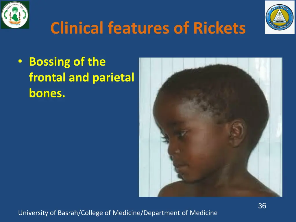 clinical features of rickets 1