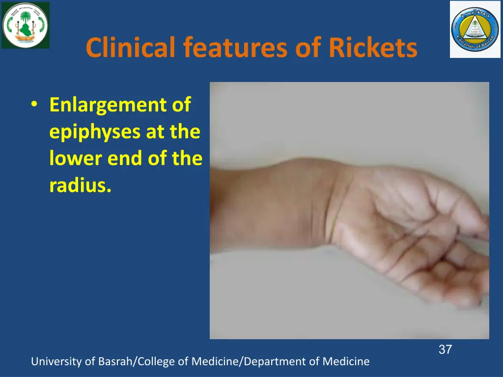 clinical features of rickets 2