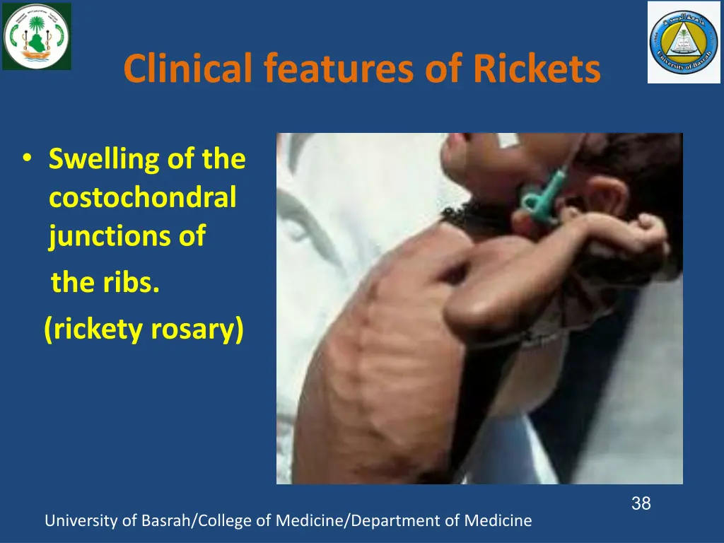 clinical features of rickets 3