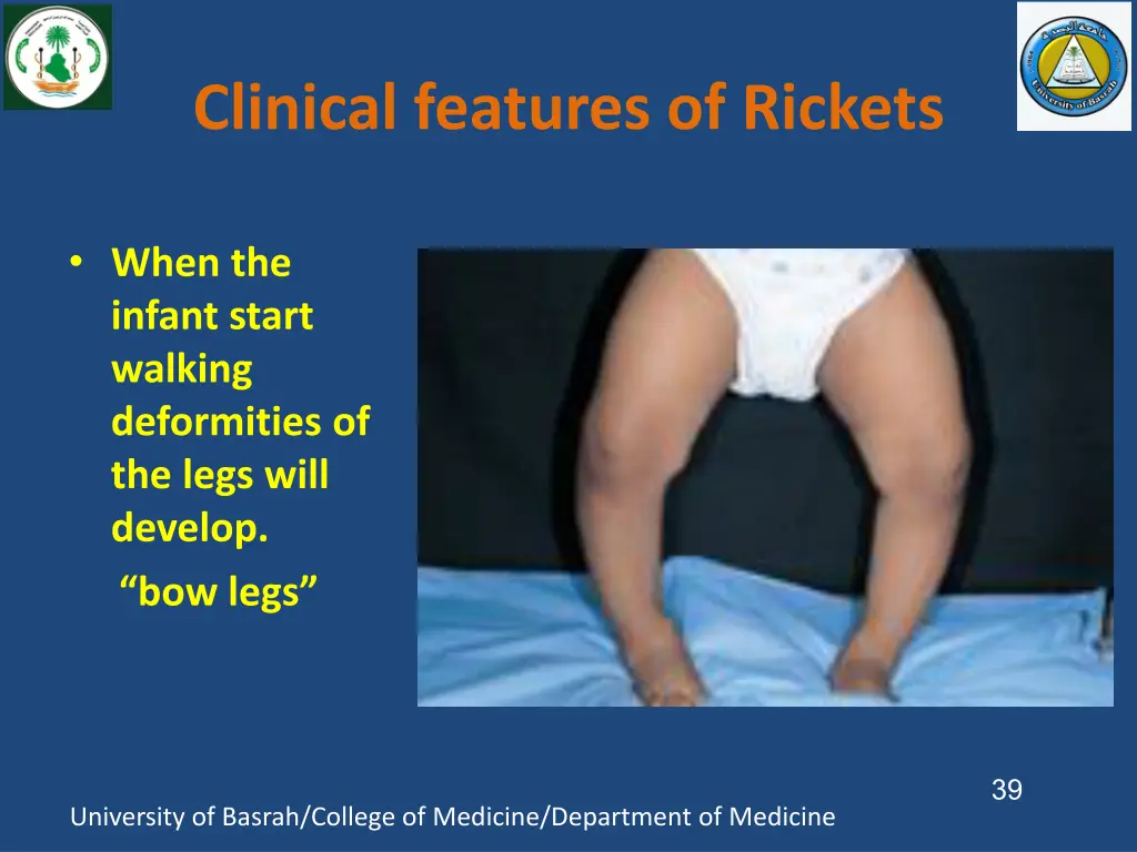 clinical features of rickets 4