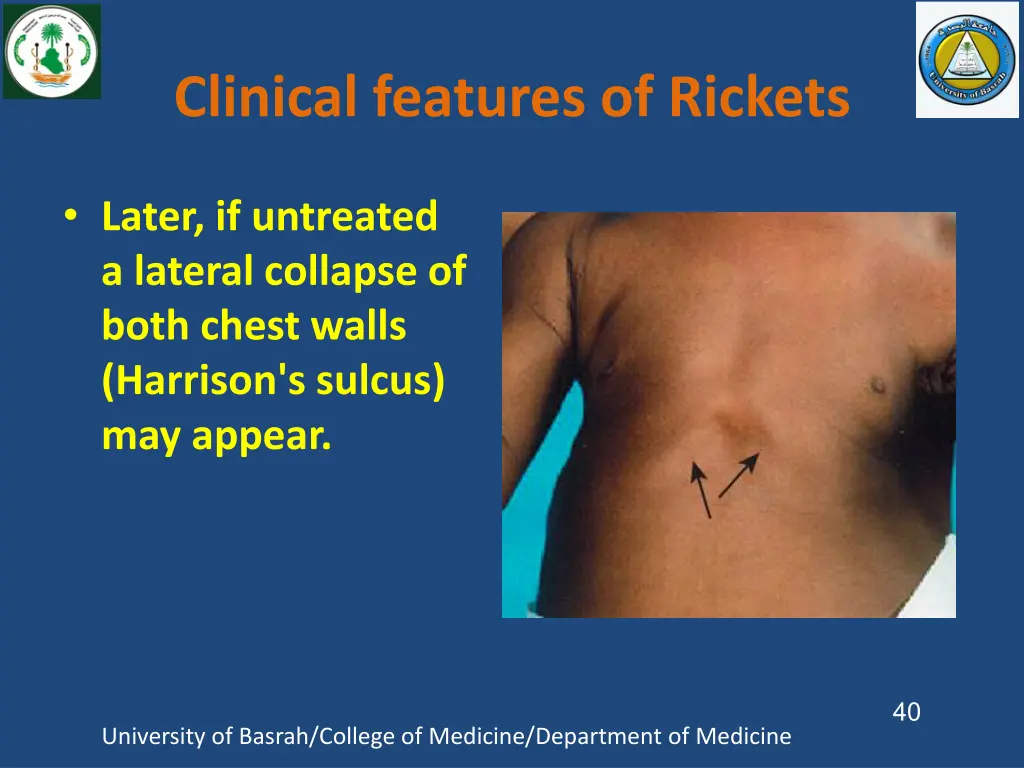 clinical features of rickets 5