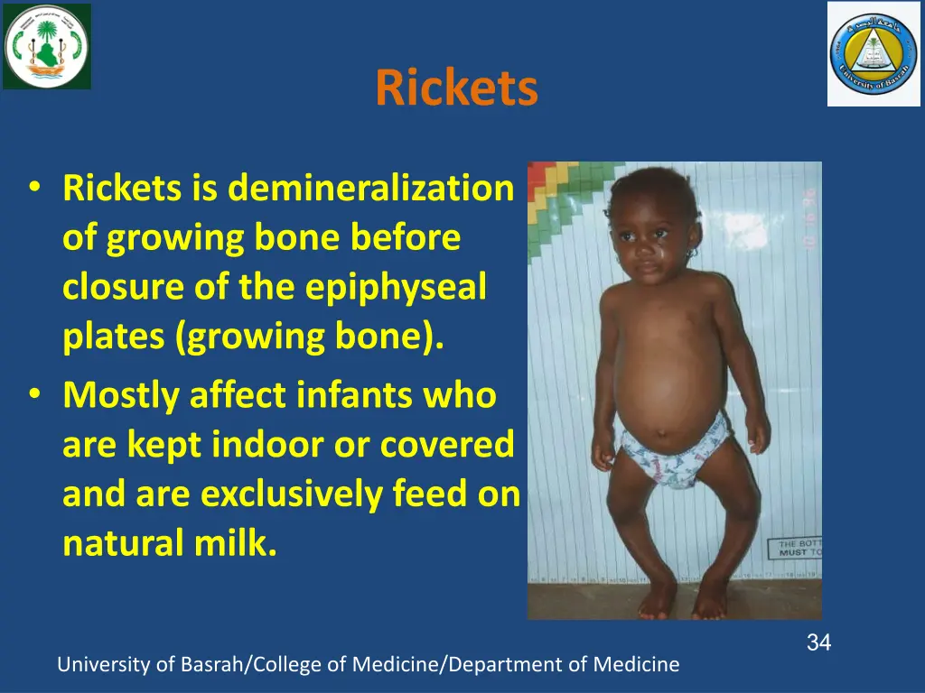 rickets
