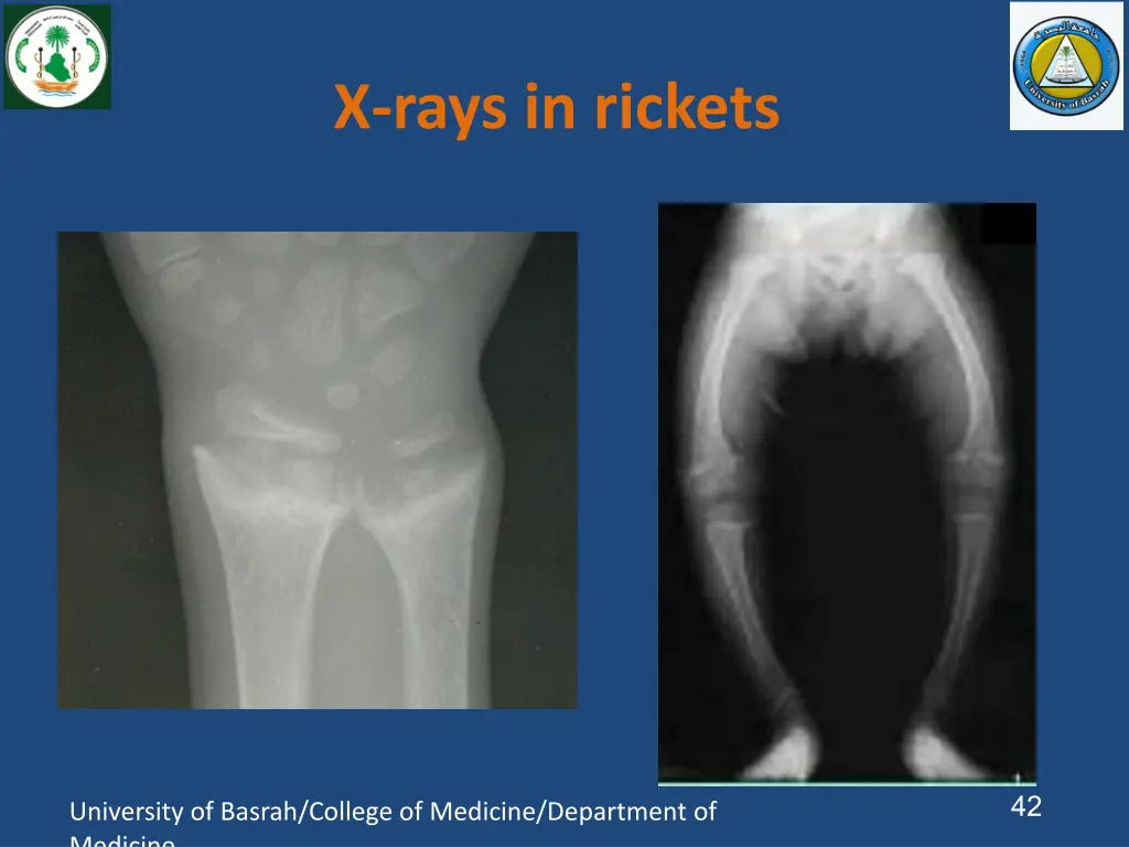 x rays in rickets