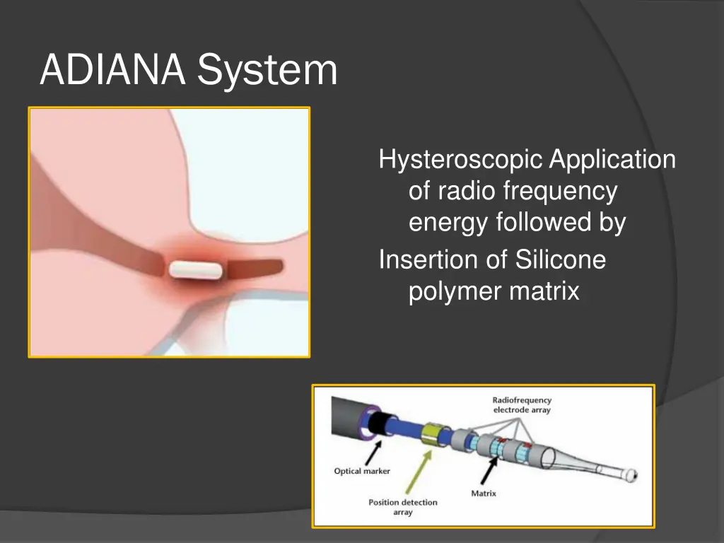 adiana system