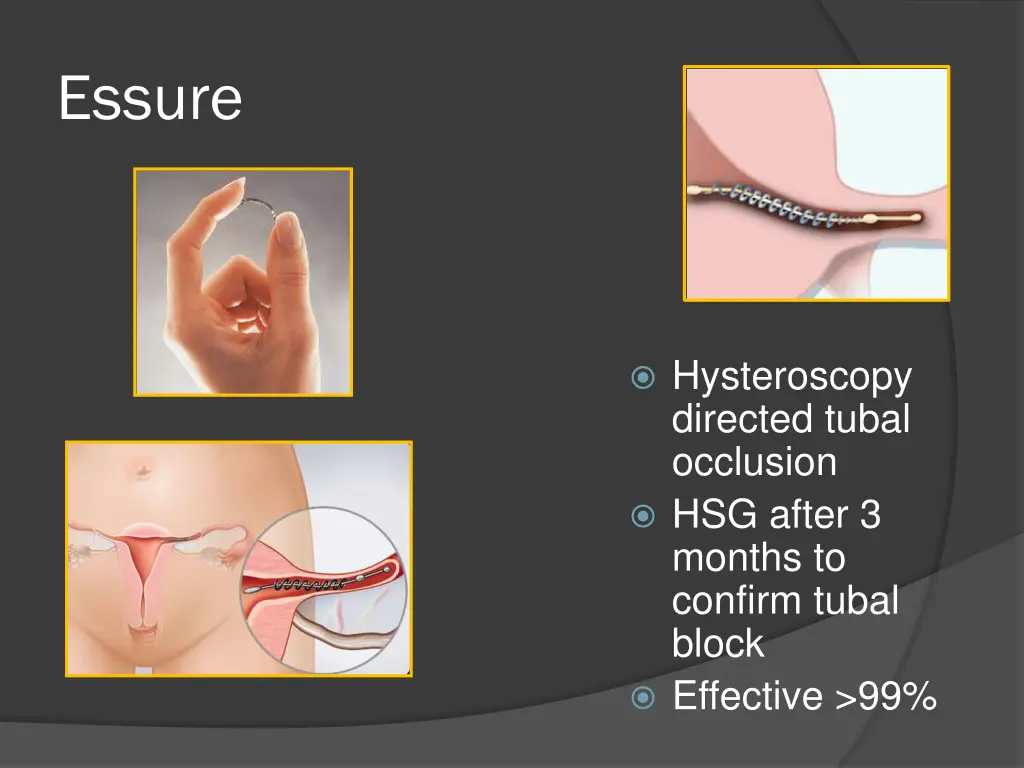 essure