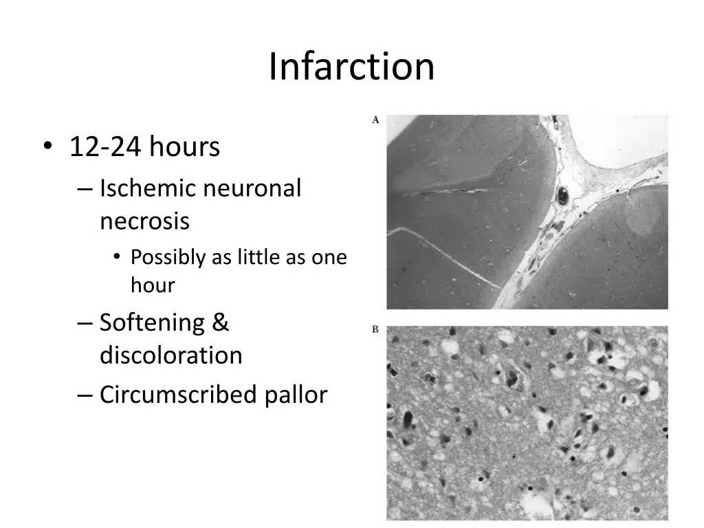 infarction