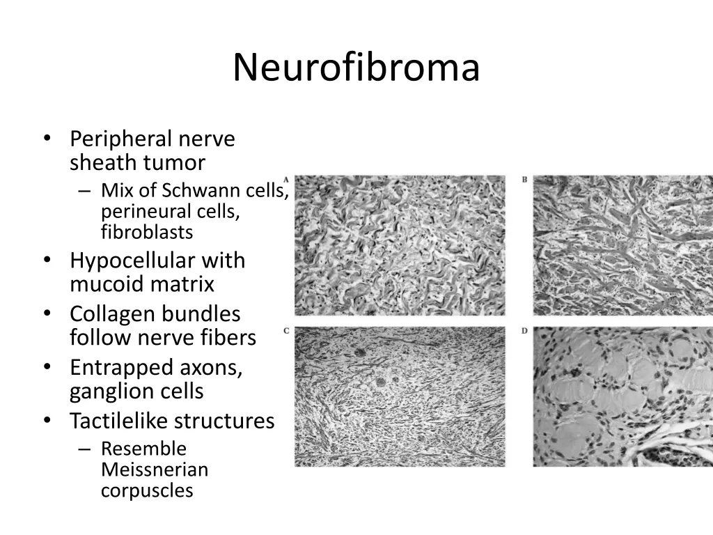 neurofibroma