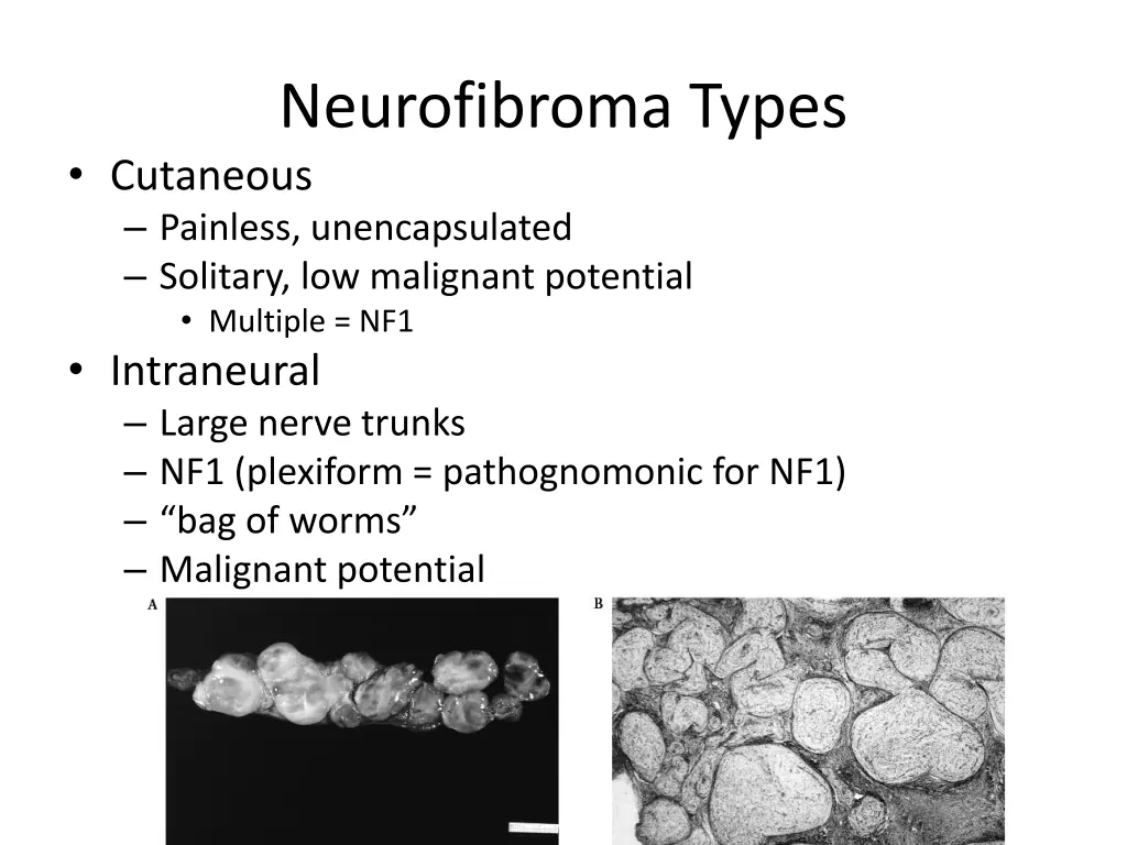 neurofibroma types cutaneous painless