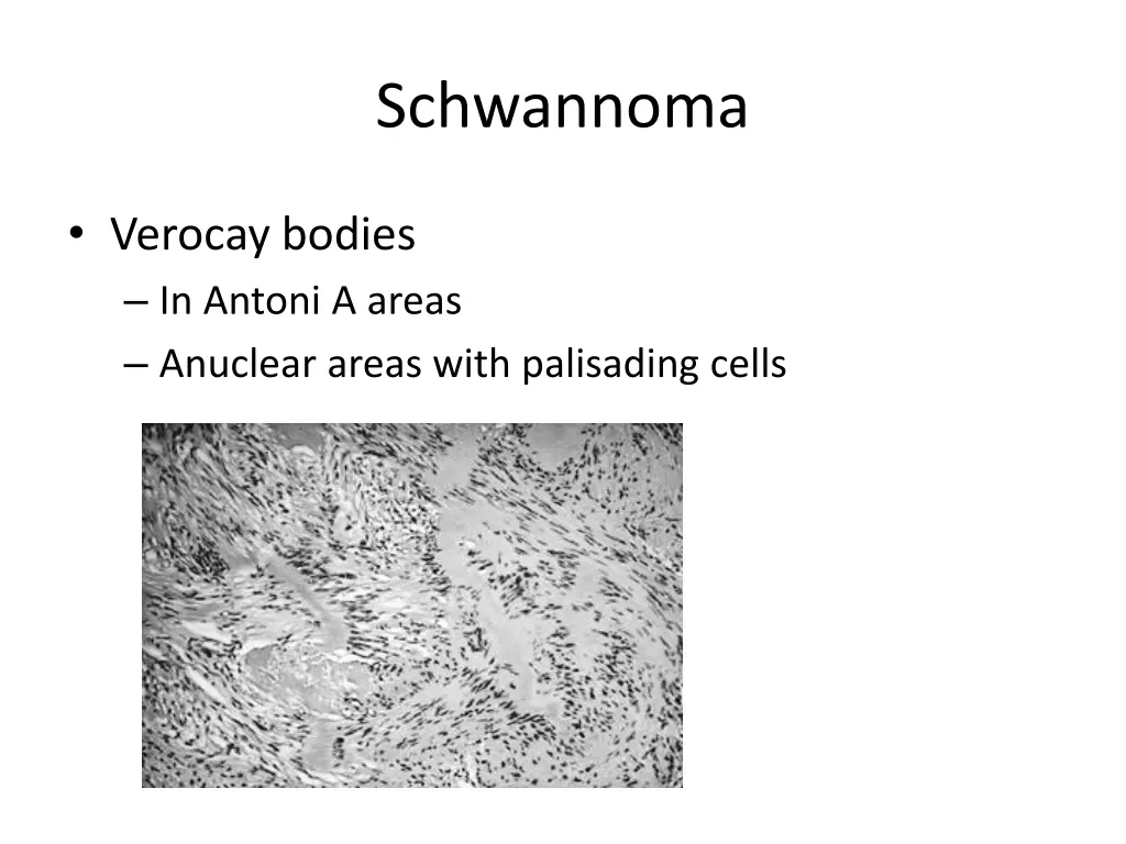 schwannoma 1