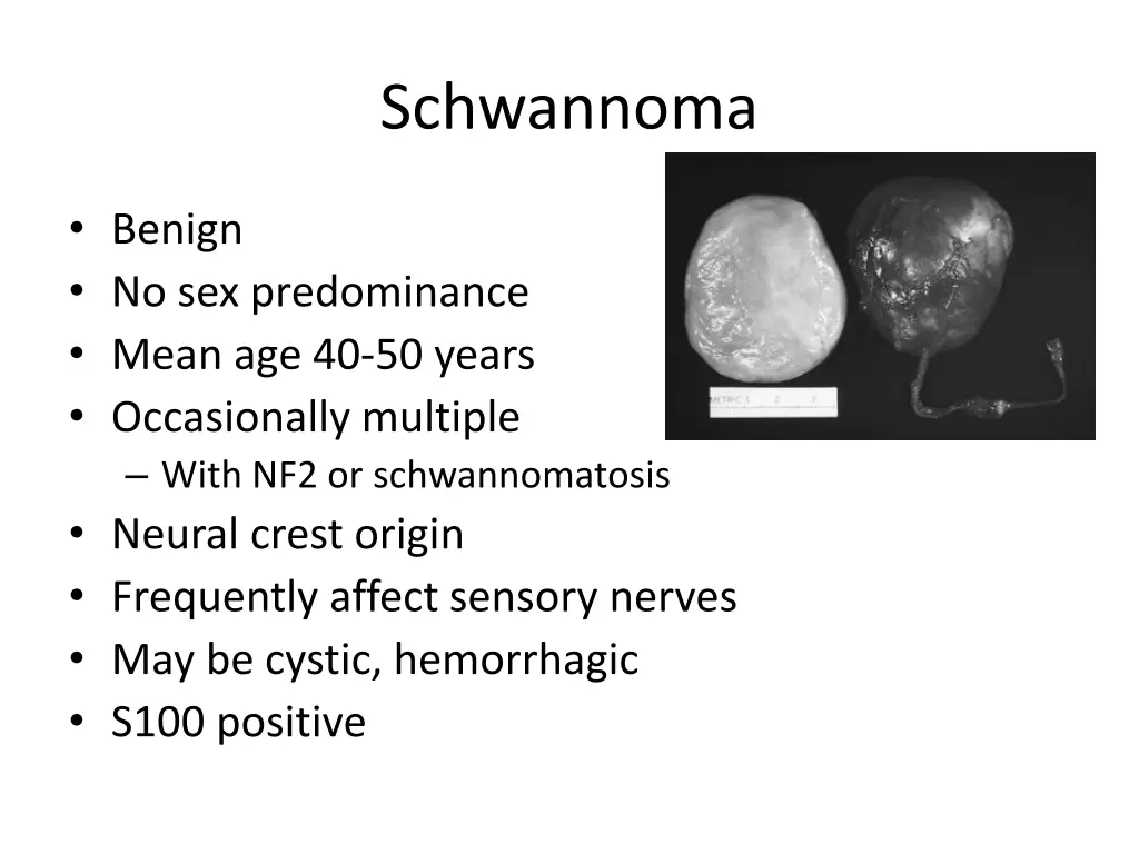 schwannoma 2