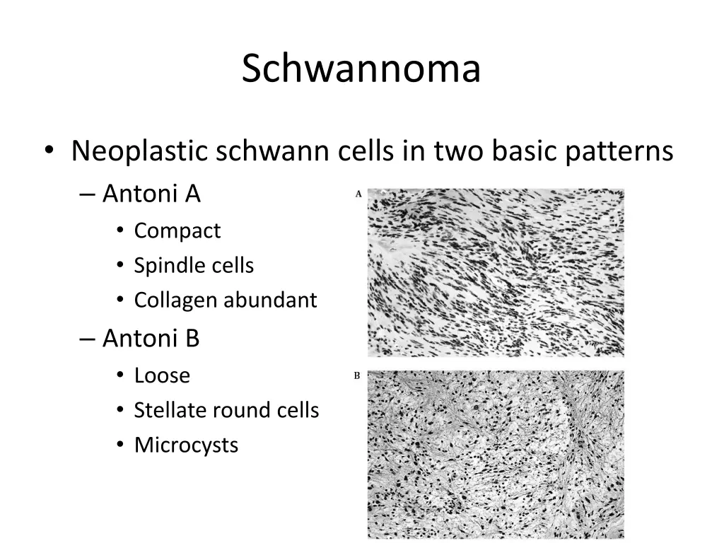 schwannoma