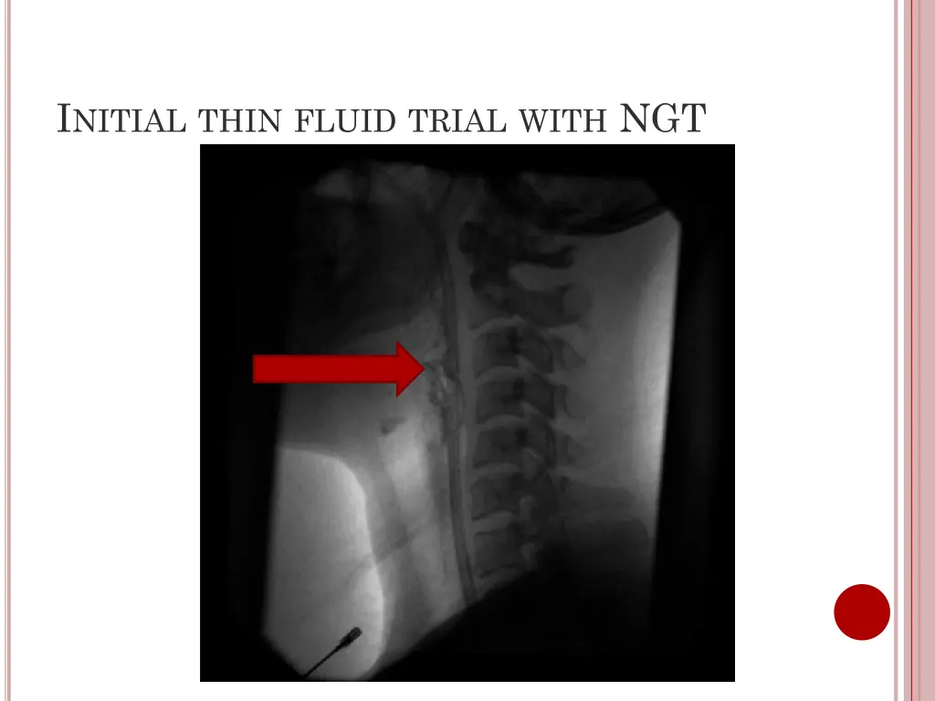 i nitial thin fluid trial with ngt