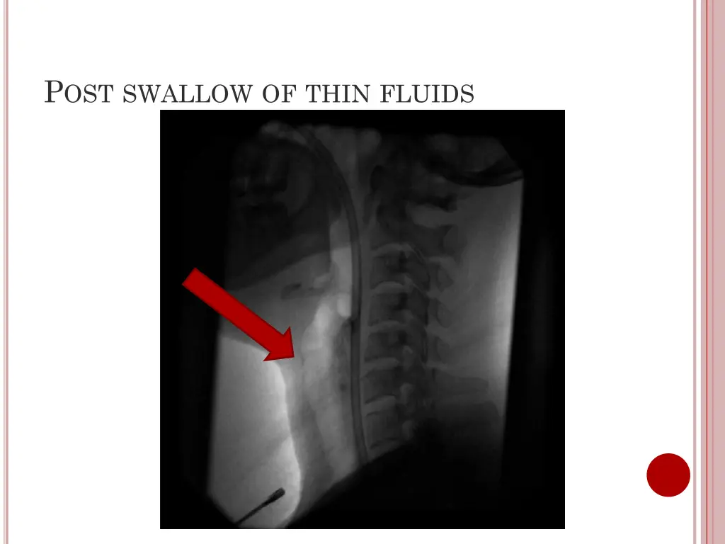 p ost swallow of thin fluids