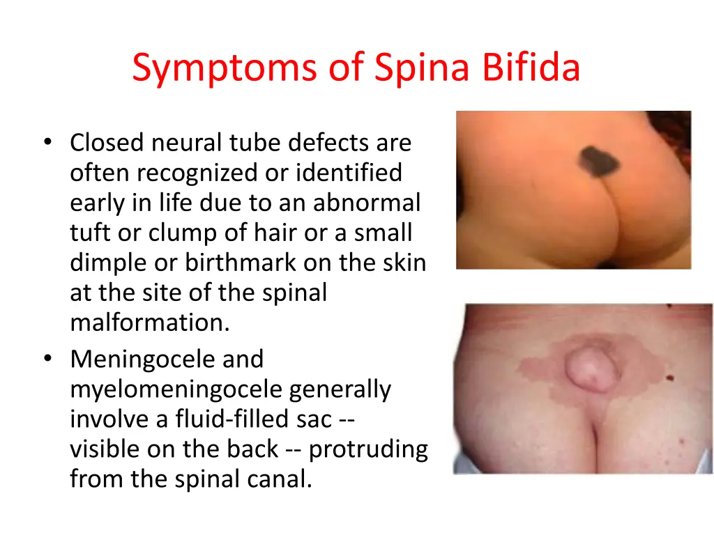 symptoms of spina bifida