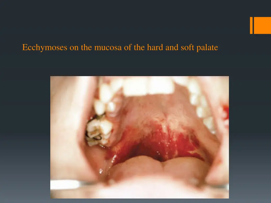 ecchymoses on the mucosa of the hard and soft