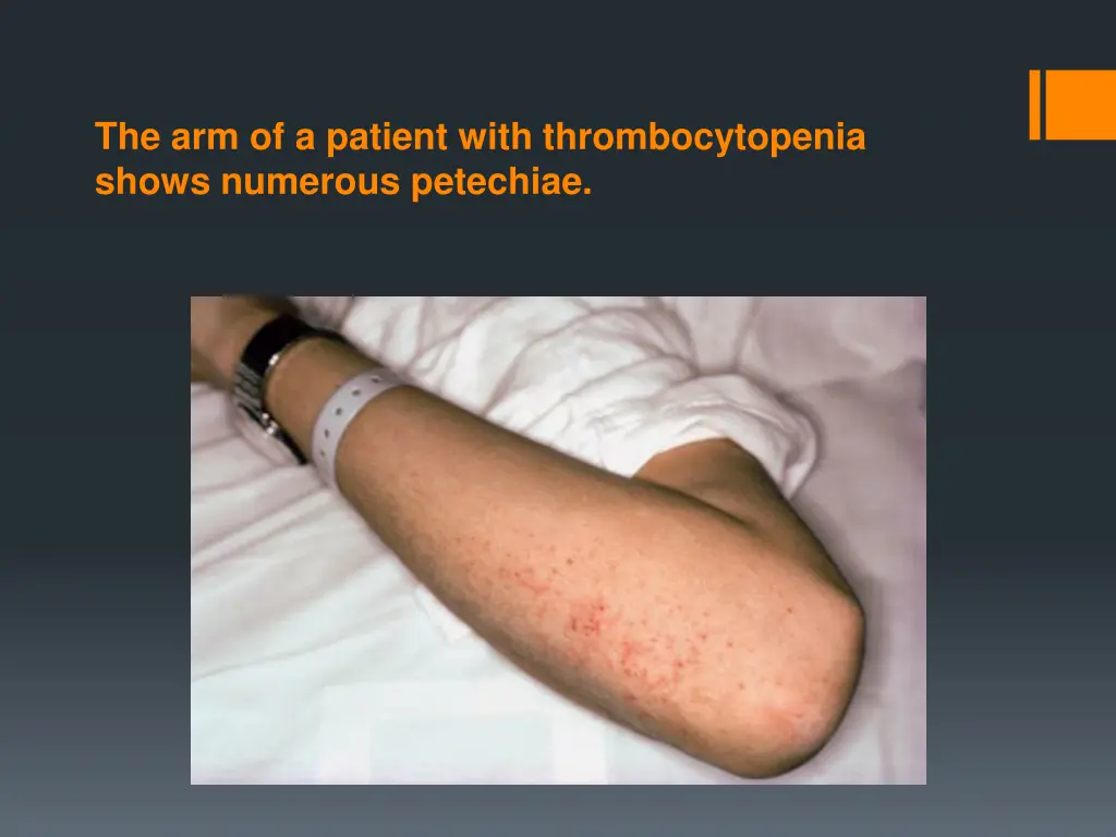 the arm of a patient with thrombocytopenia shows