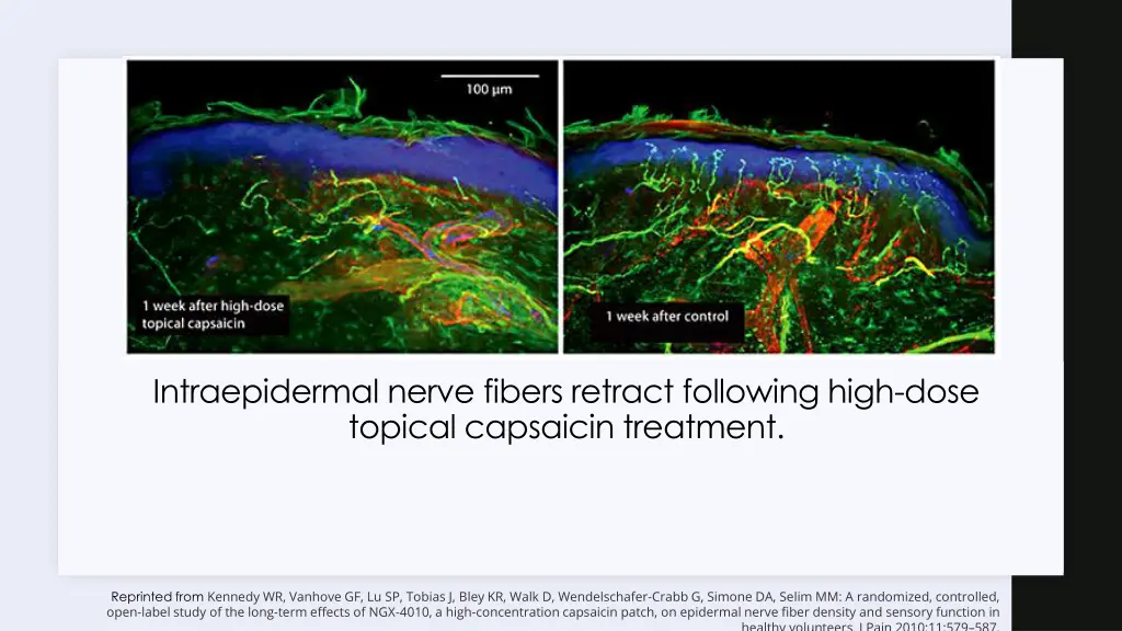 intraepidermal nerve fibers retract following
