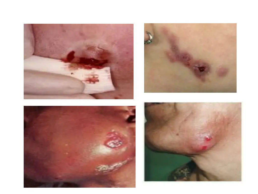 cervicofacial actinomycosis 1