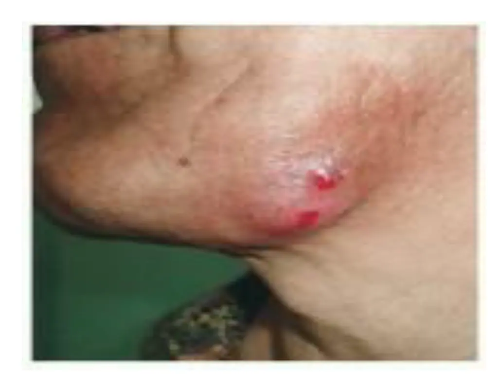 cervicofacial actinomycosis