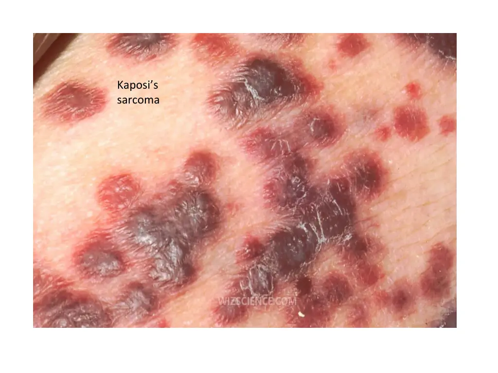 kaposi s sarcoma