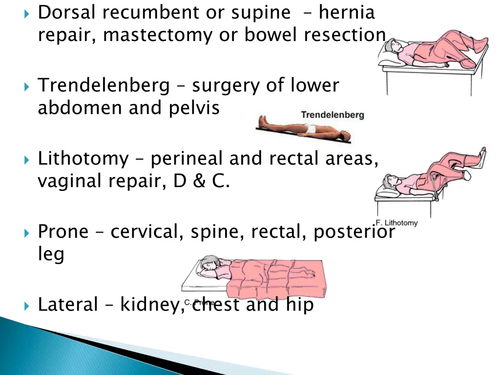 dorsal recumbent or supine hernia repair