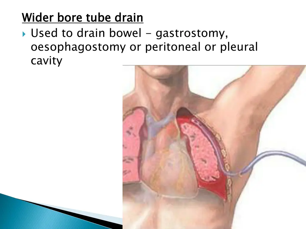 wider bore tube drain used to drain bowel