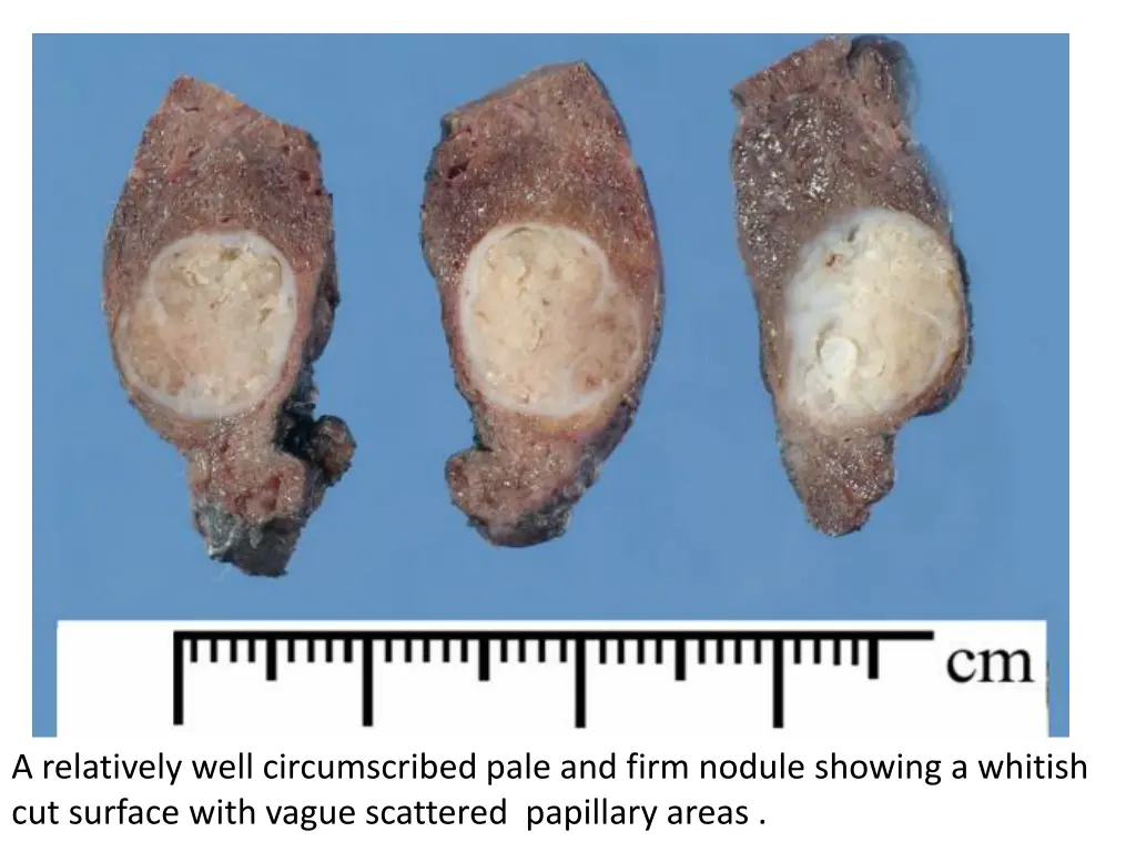 a relatively well circumscribed pale and firm
