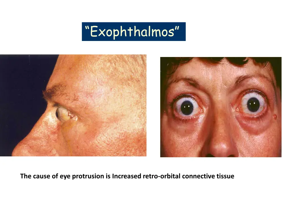 exophthalmos