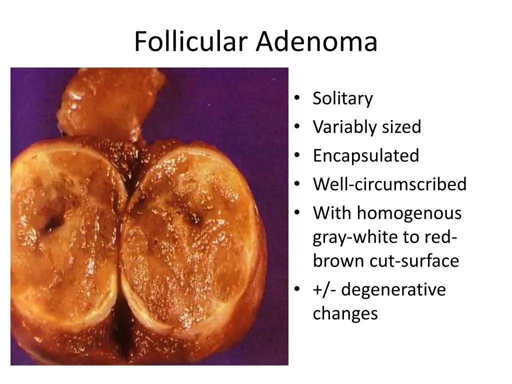 follicular adenoma