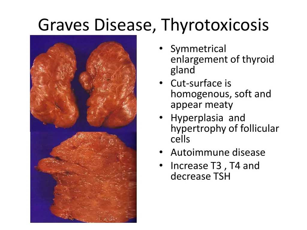 graves disease thyrotoxicosis