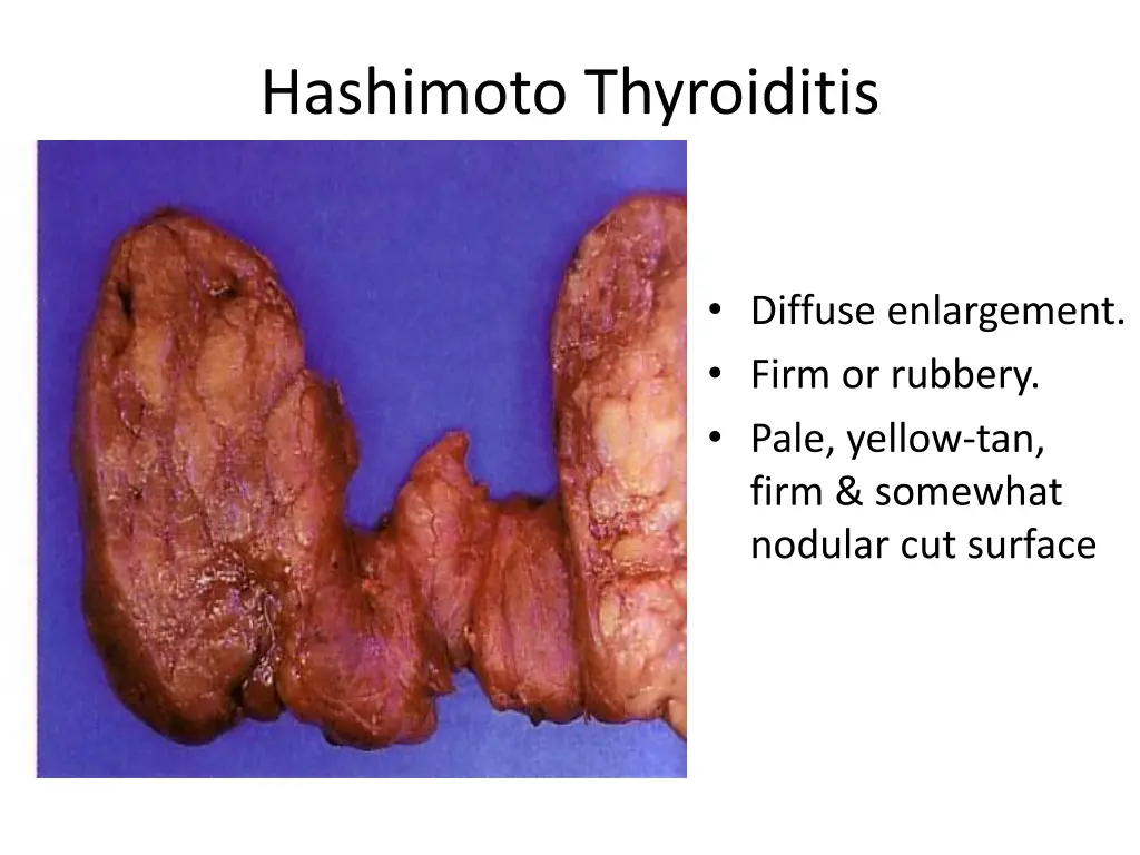 hashimoto thyroiditis