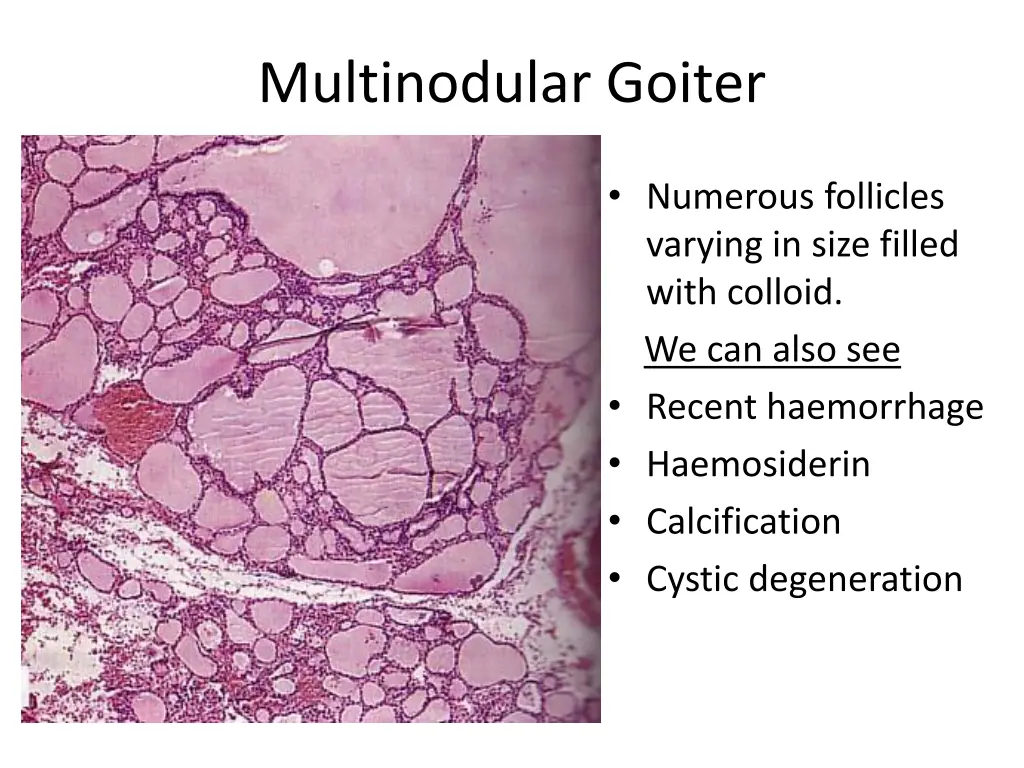 multinodular goiter 1