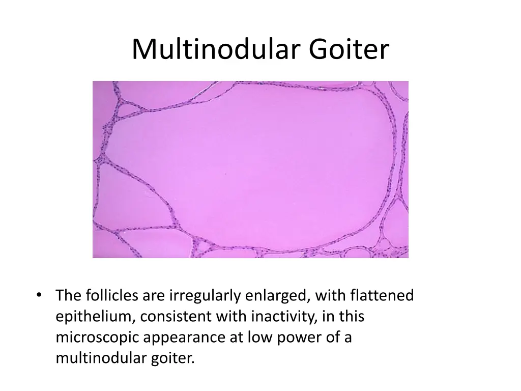 multinodular goiter 2