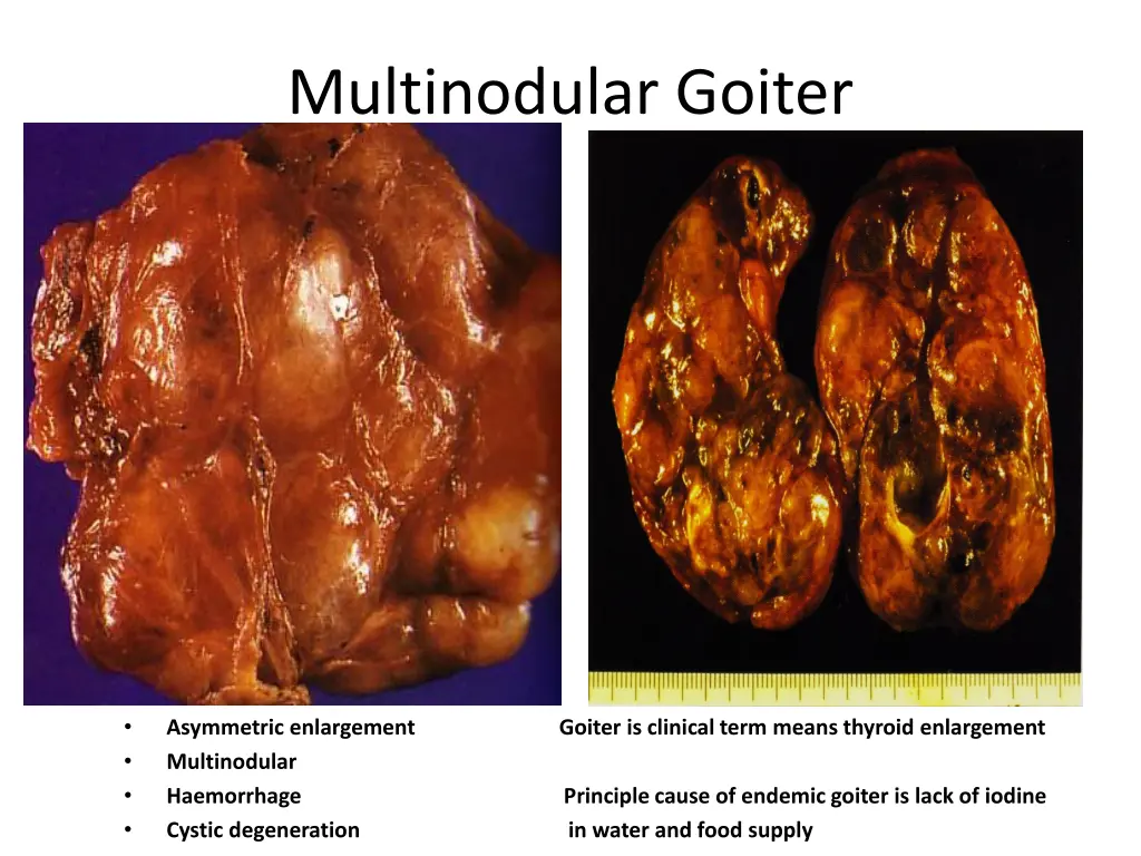 multinodular goiter
