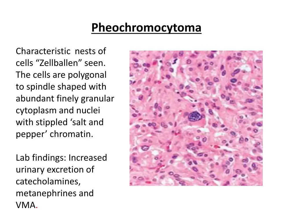 pheochromocytoma 1