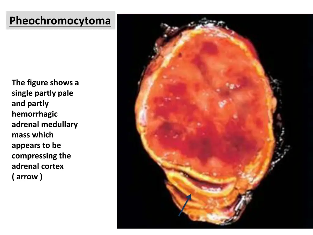 pheochromocytoma