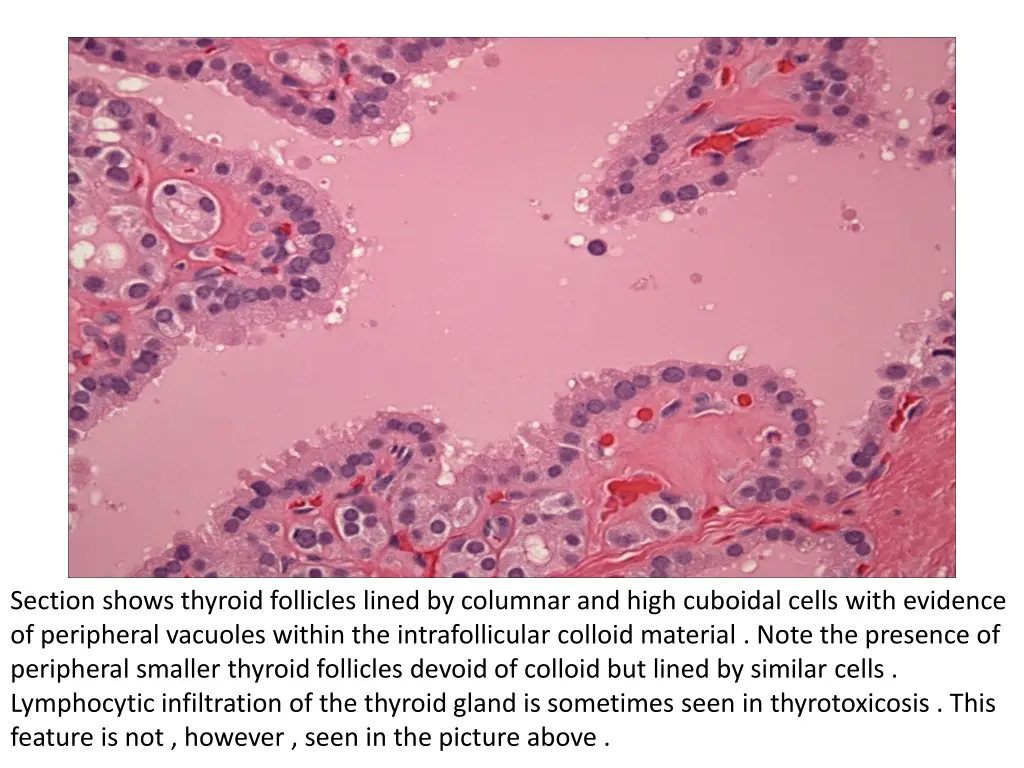 section shows thyroid follicles lined by columnar