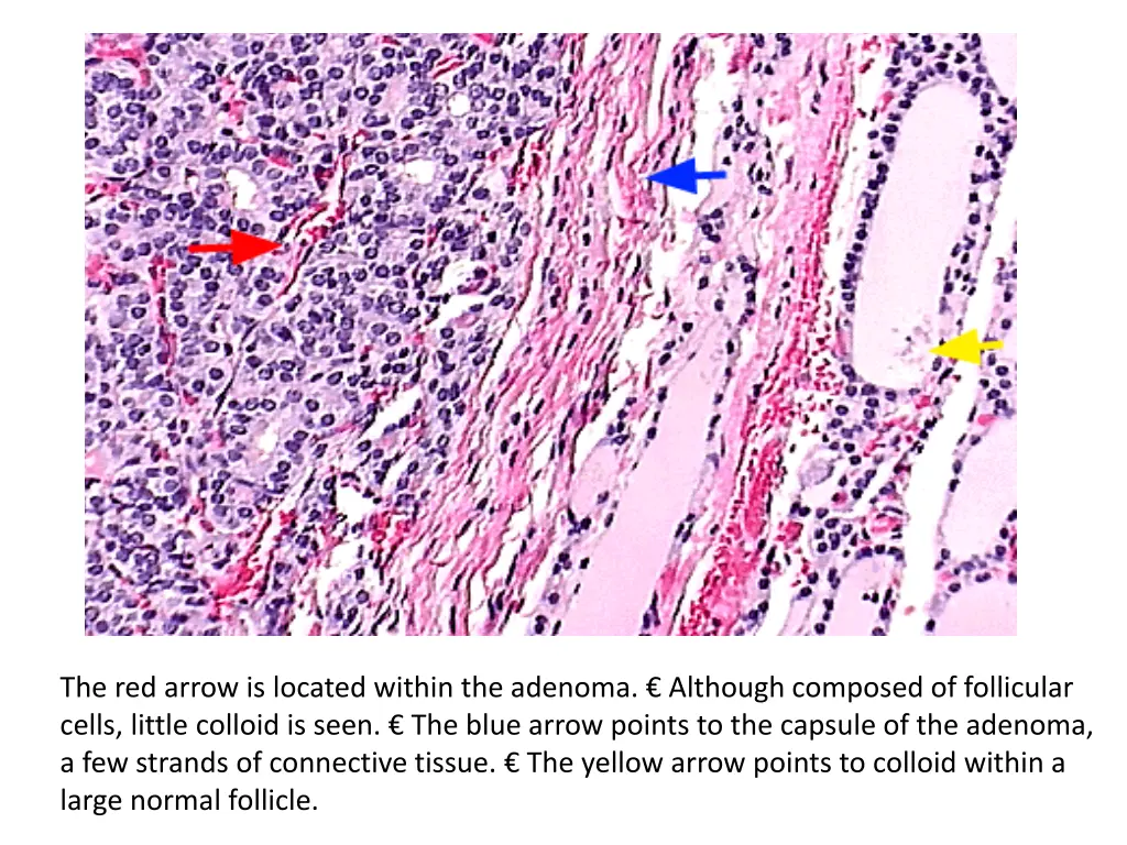 the red arrow is located within the adenoma