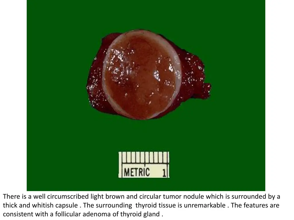 there is a well circumscribed light brown