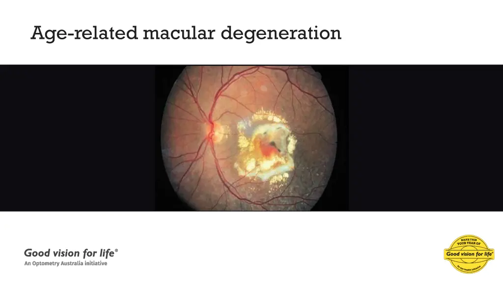 age related macular degeneration 1