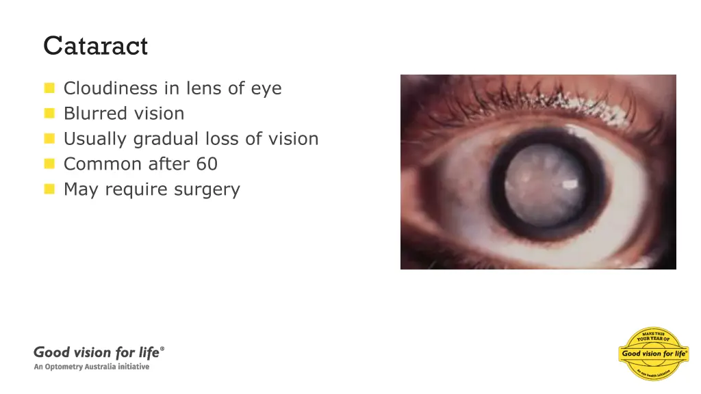 cataract