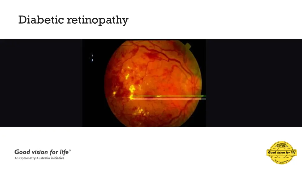 diabetic retinopathy 1