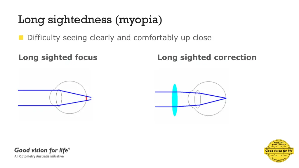 long sightedness myopia