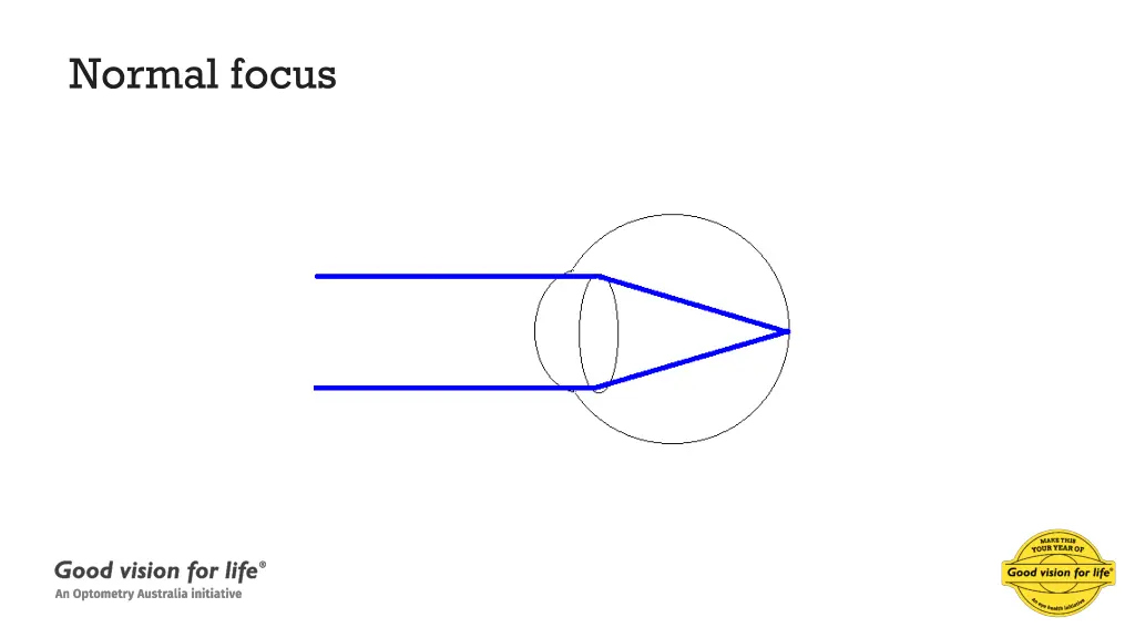 normal focus